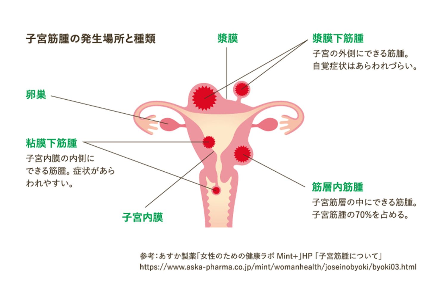 【画像】子宮筋腫の発生場所と種類
